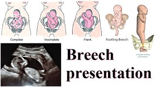 breech presentation