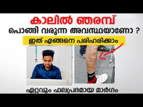എന്താണ് വെരിക്കോസ് വെയിൻ എന്താണ് പരിഹാരം ഒരുപാട് തെറ്റിദ്ധാരണകൾ