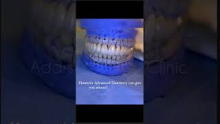 #FullmouthRehabilitation #DentalLaminates,#bestdentalclinicinchennai,#chennai#dentistry #goldcrowns