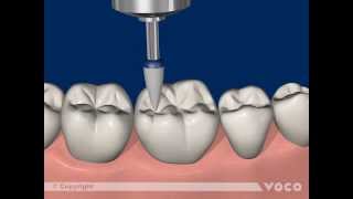 Universal adhesive Futurabond U-Part 3/12: Direct restoration with a LC composite
