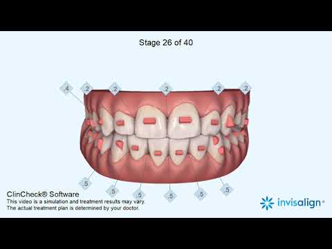 Transformations with Invisalign digital workflow