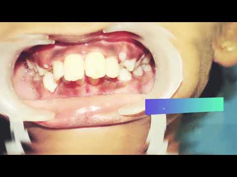Any Trauma in kids teeth shouldn't be left untreated | Dr. Hari's Dental Centre | Chennai