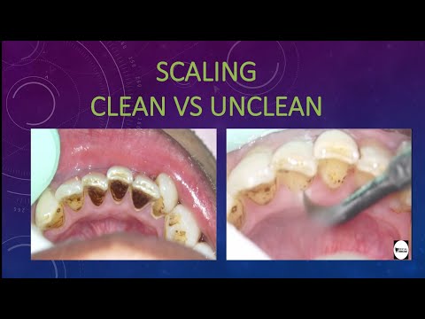 Scaling clean vs unclean challenge