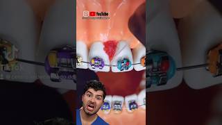 Braces Flossing Hack