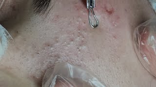 LIMPEZA DE PELE / BLACKHEAD EXTRACTION MARY PT 1 #BLACKHEADREMOVAL #BLACKHEADS #BIGBLACKHEADS 