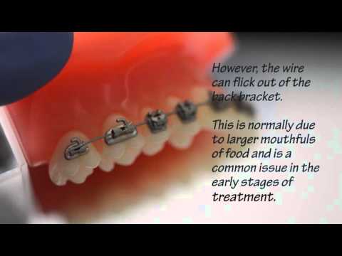 My wire has come out of the bracket at the back of my mouth!