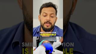 Why Digital Smile Design is Key for Smile Correction  #SmileCorrection #Dentalcare #smiledesign