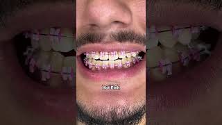 Braces Colors that make your teeth look Whiter