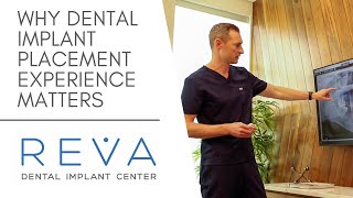 Why Dental Implant Placement Experience Matters