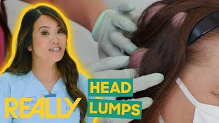 Dr. Lee Helps Twins With Golf Ball-Sized Lumps On Their Heads | Dr Pimple Popper: Pop Ups