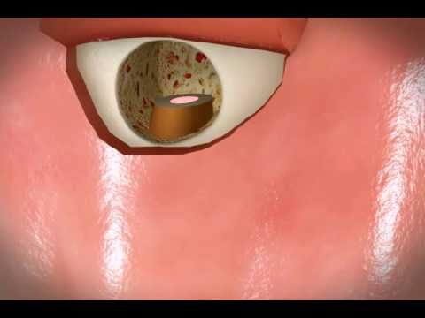 Endotontics - Surgery
