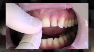 Porcelain Laminate Veneers: a perio-biomimetic approach