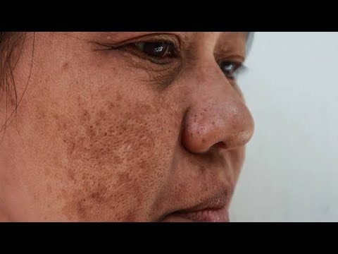 FRACKLES/PIGMENTATION/MELSMA q hojati hai reason??? ☝️#pigmentation #frackles#viralvideo #trending
