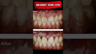 Gum Surgery Before and After #Shorts #gumsurgery #dental #dentistry #dentalcare #dentalwork #teeth
