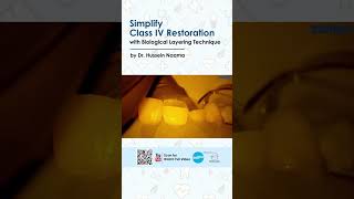 Simplify Class IV Restoration with MiCD Biological Layering Technique by Dr Hussien Naama