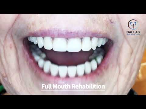 [Dallas Dental Implant Center] Full Mouth Rehabilition video