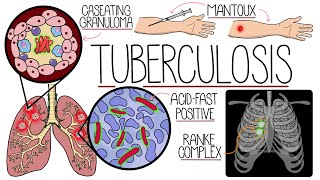 Understanding Tuberculosis