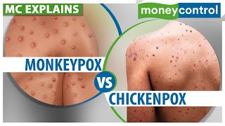 Monkeypox: How Is It Different From Chickenpox | Explained