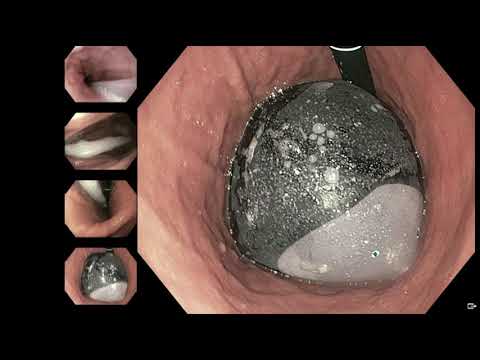 Insertion of Orbera 365: Dr Saurabh Gupta, Sydney, Australia
