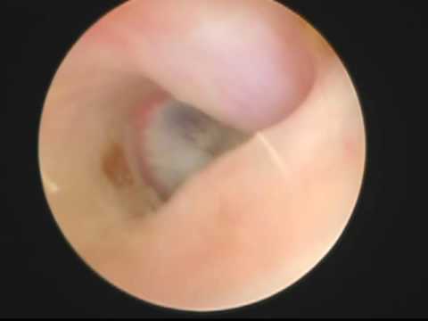 Video-otoscopy. Pars Flaccida.