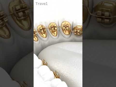 What are Lingual Braces?