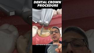 How to Prepare for a Dental Crown (SIMPLY EXPLAINED) | In Office to Hands On Dental Training #shorts