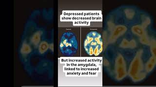 Brain scans of psychiatric disorders #facts #brainlearning #neuroscience #science #brainscience