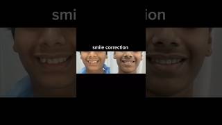 Smile Correction|Braces treatment|Smile transformation #shorts #ytshorts
