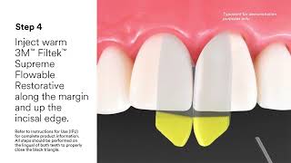 3M™ Filtek™ Dental Restoratives and Bioclear®