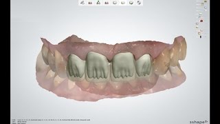 Design frameworks with realistic mamelon structures for anterior cases