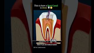 Root canal treatment #dental #rct #rootsreggae #rootcanalspecialist #dentalclinic #ambeydentalclinic