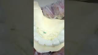 PFM bridge #crownandbridge #dentistry #pfm #dentist #missingteeth #fixed #fixedteeth
