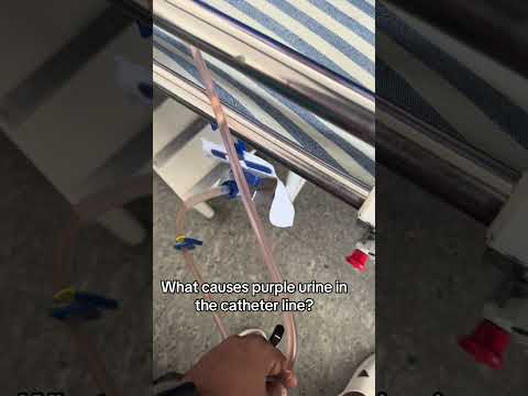 Why is the catheter line turning purple?