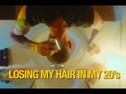 Losing my hair in my 20's