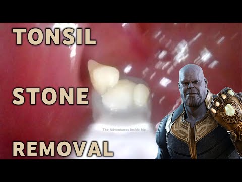 Tonsil Stone Removal | AIM 16