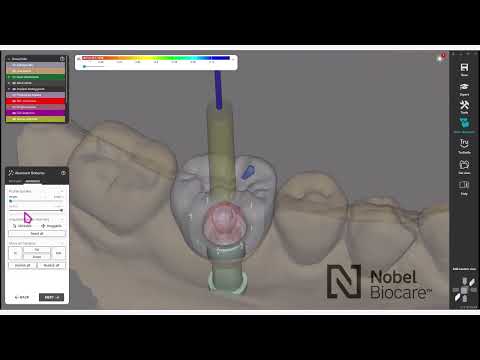 How to design your NobelProcera® Full-contour Zirconia Implant Crown using exocad™