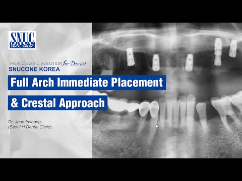 [SNUCONE IMPLANT] Full Arch Immediate Placement & Crestal Approach
