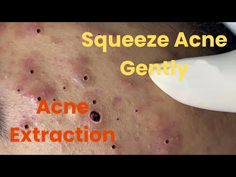 Best Blackheads Whiteheads Removal Pimple Spa