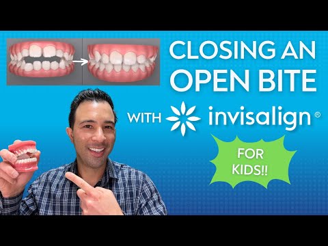 Closing an Eight-Year-Old's Open Bite With INVISALIGN!