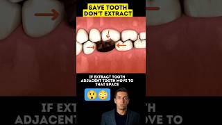 Don't Extract Tooth if you can Save it😳😲 Save Tooth🔥🔥 #shorts #shortsfeed #dentist #healthtips