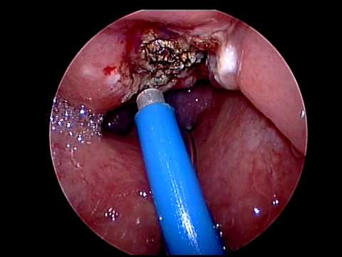suction diathermy adenoidectomy
