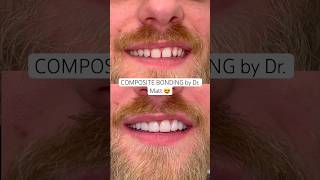 No drilling or injections used to transform this smile with composite bonded veneers. #ruhdental ❤️