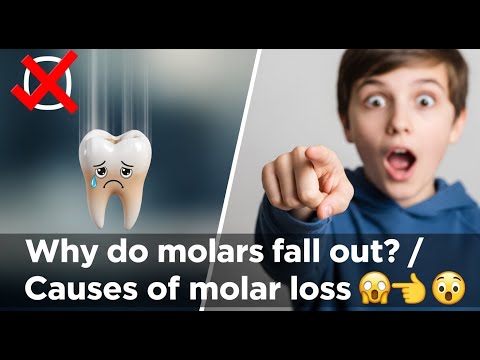 ✅ Why do molars fall out? / Causes of molar loss 👈😳