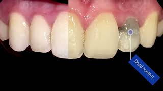 Internal bleaching..DEAD tooth, back to life 👌