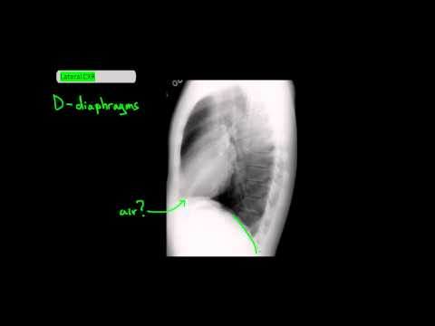 Method to Read Lateral Chest X-Rays [UndergroundMed]