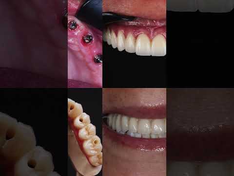 All on Six Zirconia Implants by Dr. Juan Fernando Uribe, Cali Dentist (Dental Tourism Colombia)