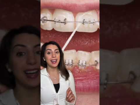 if you have #braces, listen to Dr Mackie and use #orthobuddy! #shorts