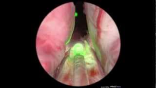 CyberSym - Surgical Simulation for Laser Prostate treatment developed by VirtaMed AG