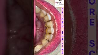 Teeth Cleaning by Doctor #scaling #teethcleaning #dentist