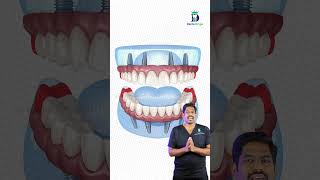 12 பற்கள் போதுமா? - All on 4 Dental Implant Method | Dr. Karthikeyan | Denta Kings #shorts